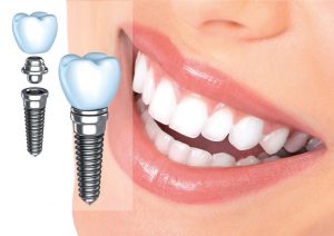 Противопоказания к зубным имплантантам — описание от стоматологии в Воронеже